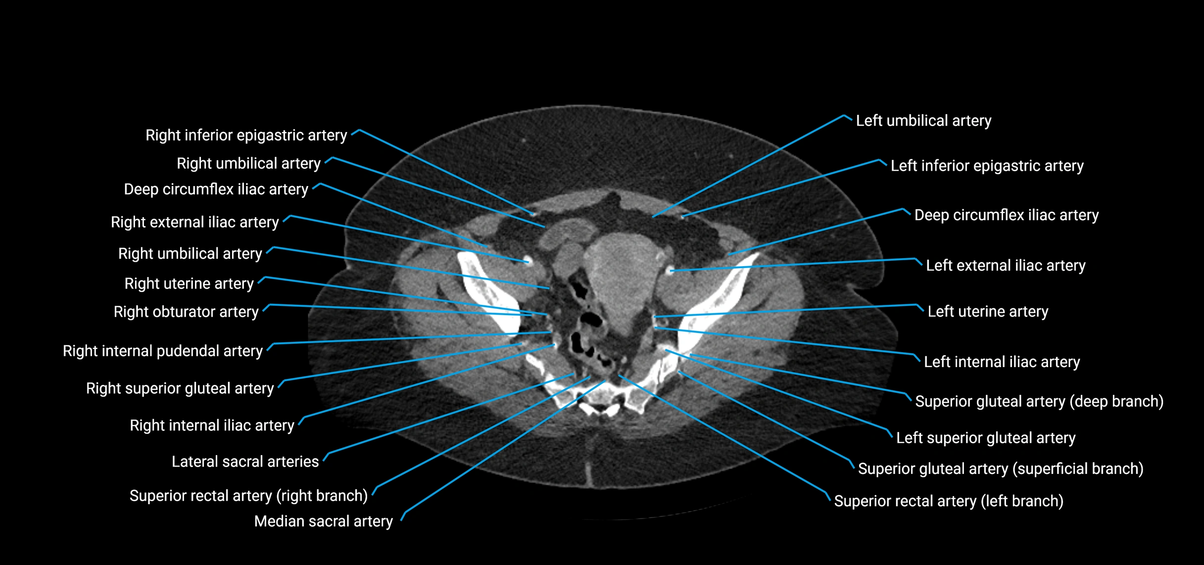 CTA abdomen axial cross sectional anatomy labelled image_213 (2).webp